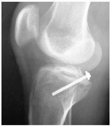 PCL Screw Fixation